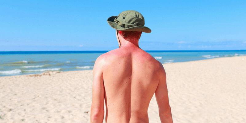 درمان آفتاب سوختگی با این ۱۹ روش موثر +‌ عکس و فیلم