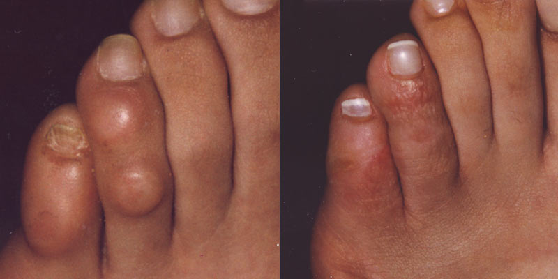 درمان قطعی میخچه کف پا | تفاوت میخچه و پینه پا در چیست