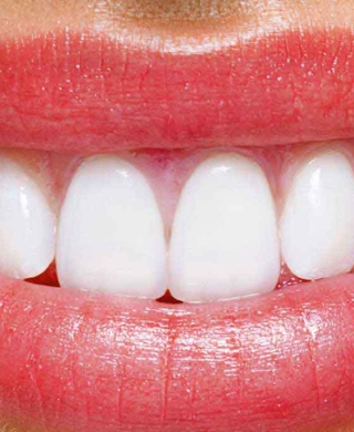 لبخند هالیوودی با اصلاح طرح لبخند